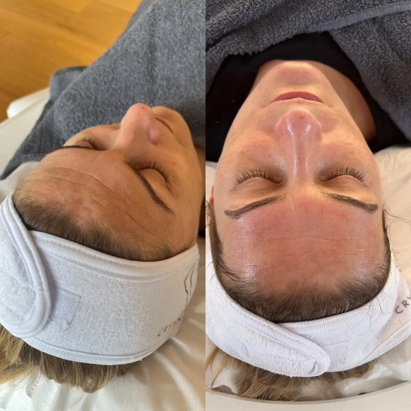 Crystal Clear SKINSTORM Before & After