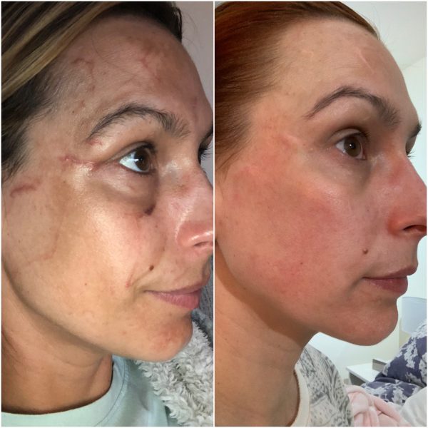 Crystal Clear SKINSTORM Scarring Before & After